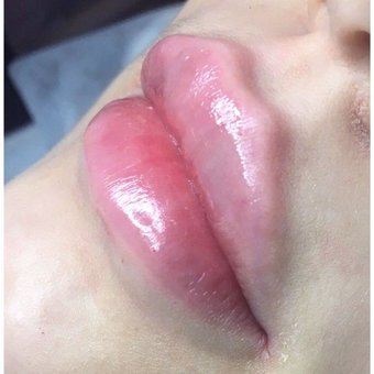 Lip augmentation in cosmetology "Touch Light Cosmetology" Kiev. Sign up for a lip augmentation at a discount.