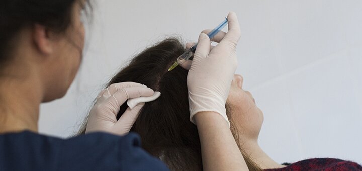 Плазмоліфтінг шкіри голови в клініці «rubenhair»