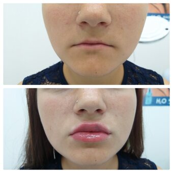 Lip augmentation in the cosmetology studio of Lyudmila Grushko. Sign up for a discount