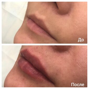 Correction of the shape of the lips in the cosmetology studio of Lyudmila Grushko. Sign up for a discount