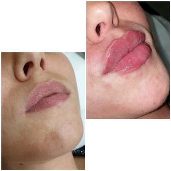 Косметолог Олена Кузьменко в києві. акції на пластику губ.