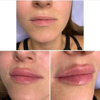 Косметологічний кабінет Олени Кузьменко в Києві. поліпшення форми губ недорого.